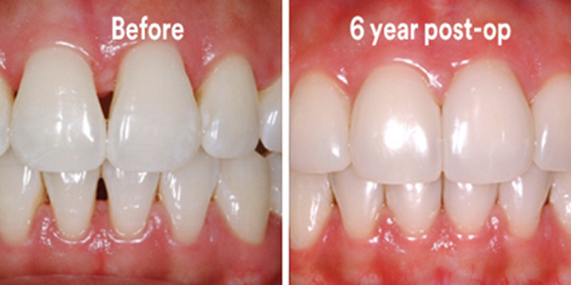 BioClear Diastema Closure and Black Triangle Closure  - Smile View Dental, West Chicago Dentist