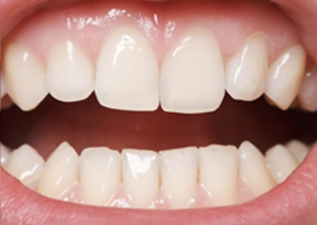 Cosmetic Bonding  - Smile View Dental, West Chicago Dentist