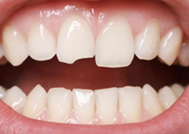 Cosmetic Bonding  - Smile View Dental, West Chicago Dentist