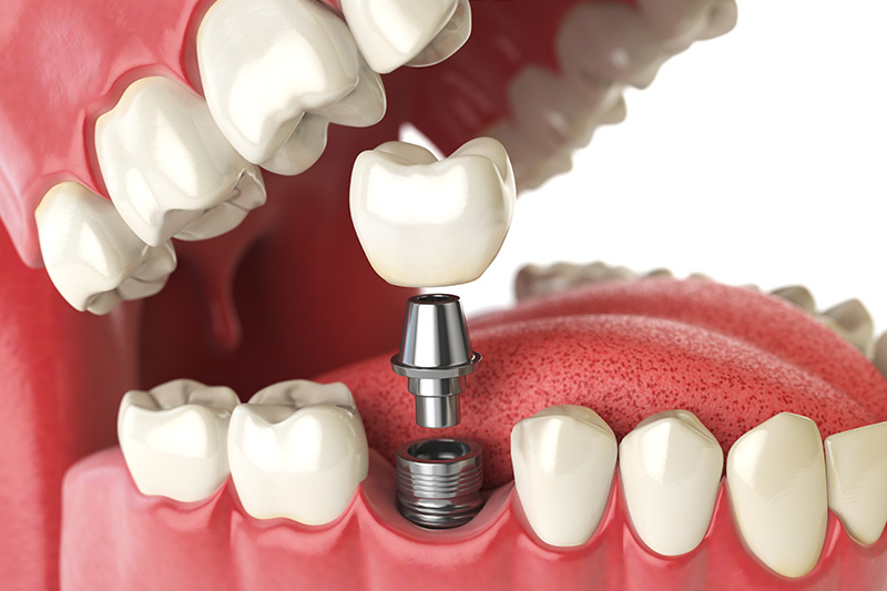 Dental Implants - Smile View Dental, West Chicago Dentist