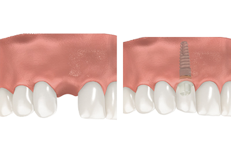 Dental Implants - Smile View Dental, West Chicago Dentist