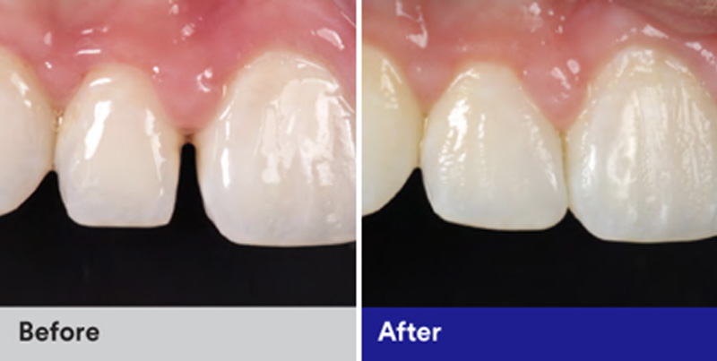 BioClear Diastema Closure and Black Triangle Closure  - Smile View Dental, West Chicago Dentist