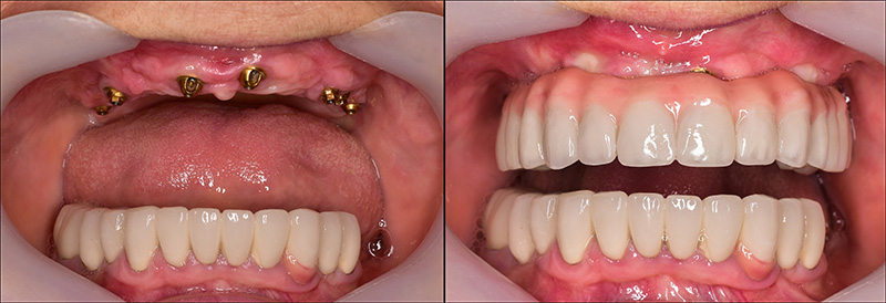 Implant Overdentures and Fixed All-On-X Treatment  - Smile View Dental, West Chicago Dentist