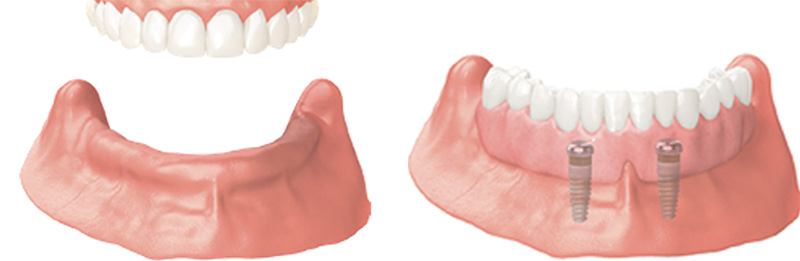 Implant Overdentures and Fixed All-On-X Treatment  - Smile View Dental, West Chicago Dentist