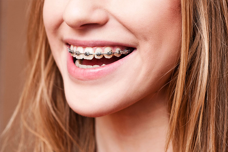 Orthodontics - Smile View Dental, West Chicago Dentist