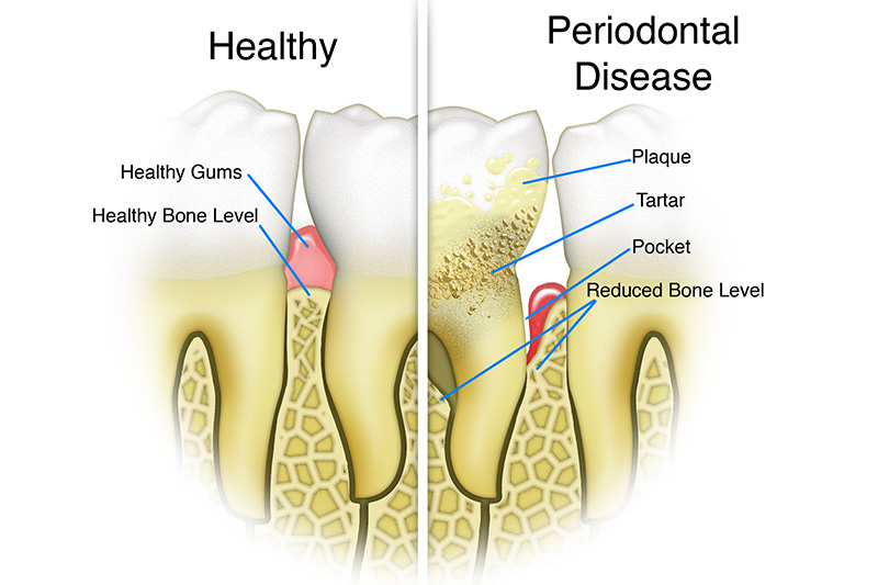 Scaling & Root Planings (Deep Cleanings)  - Smile View Dental, West Chicago Dentist