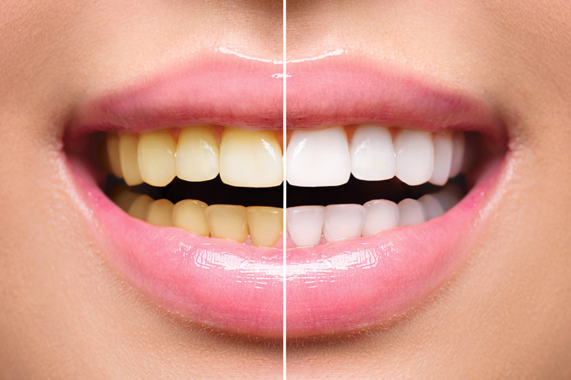 Teeth Whitening - Smile View Dental, West Chicago Dentist