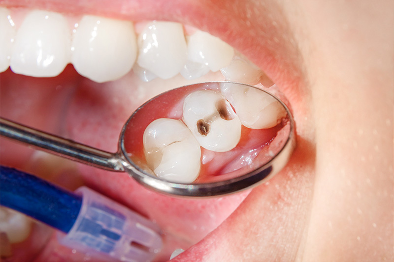 Tooth Colored Composite Fillings  - Smile View Dental, West Chicago Dentist