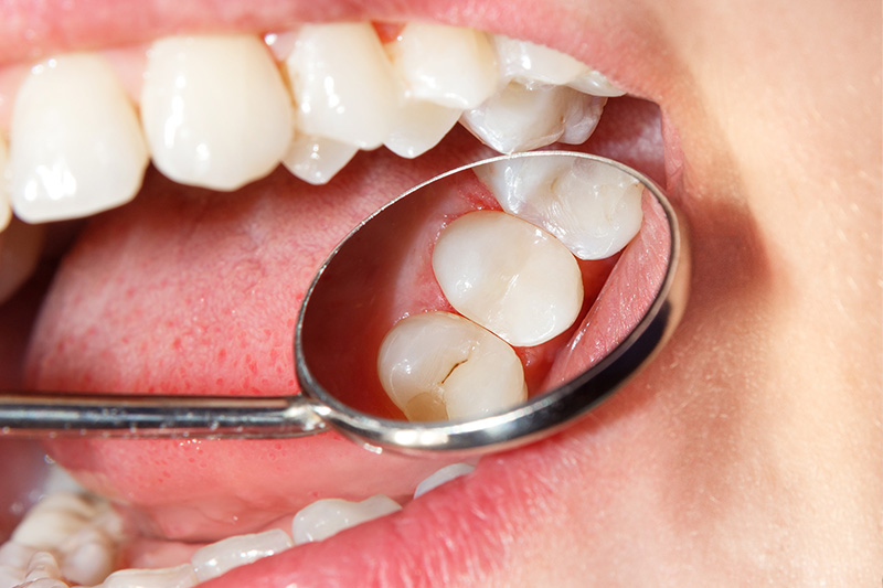 Tooth Colored Composite Fillings  - Smile View Dental, West Chicago Dentist