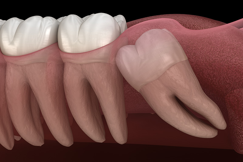 Extracciones de Muelas del Juicio (con Sedante)  - Smile View Dental, West Chicago Dentist